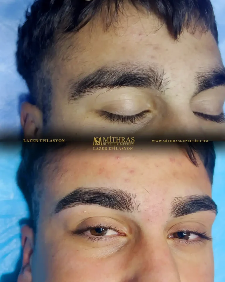 Diyarbakır erkek lazer epilasyon ile kaş tasarımı öncesi ve sonrası – örnek 18